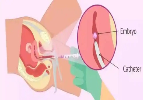 偶發(fā)還是遺傳？看看4號(hào)染色體三體異?，F(xiàn)象的真正原因